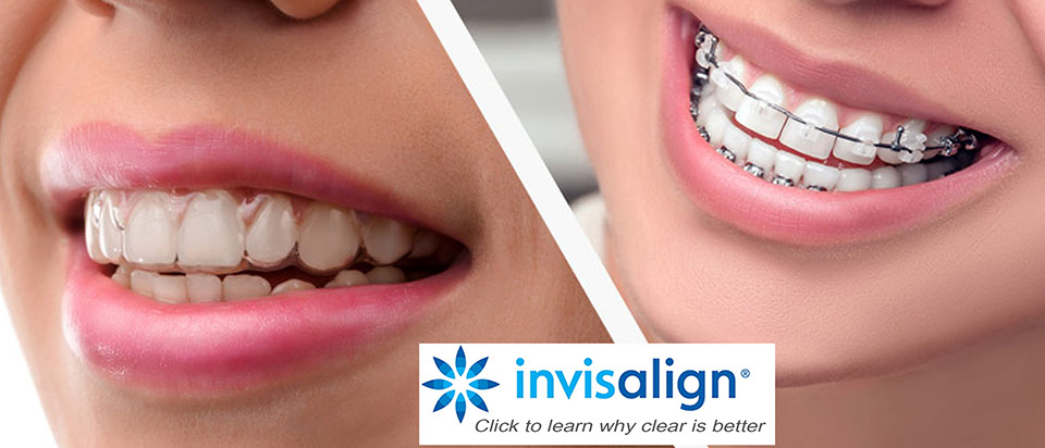 Photo of smile with Invisalign vs wire braces. Both straightens out teeth, but Invisalign is simply better.